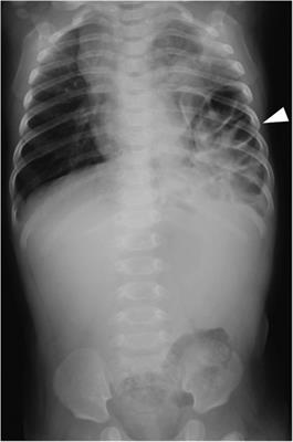 Case Report: Retropancreatic fascia hernia protruding into the thoracic cavity through a Bochdalek hernia